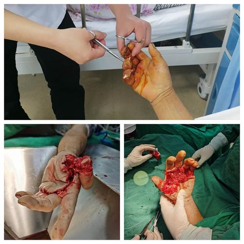 长航东院骨科:断指再植东院行 连夜手术为病人