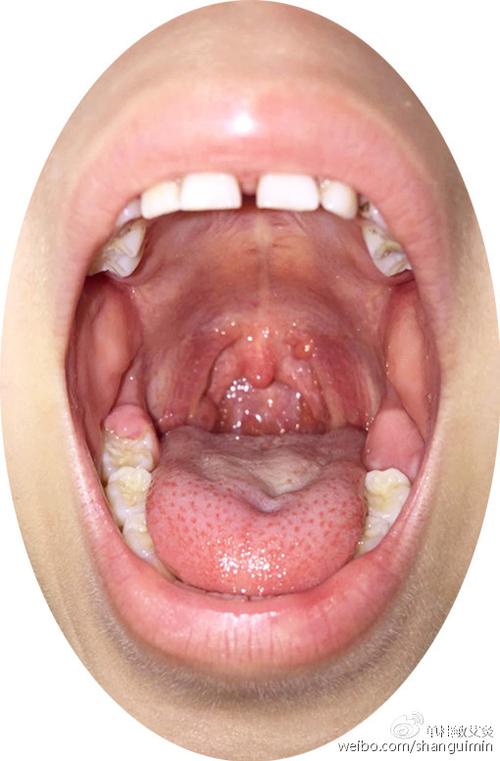 火针治疗小孩咽炎