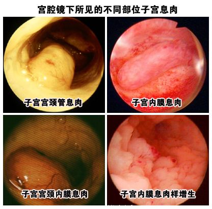 子宫内膜息肉,切还是不切?