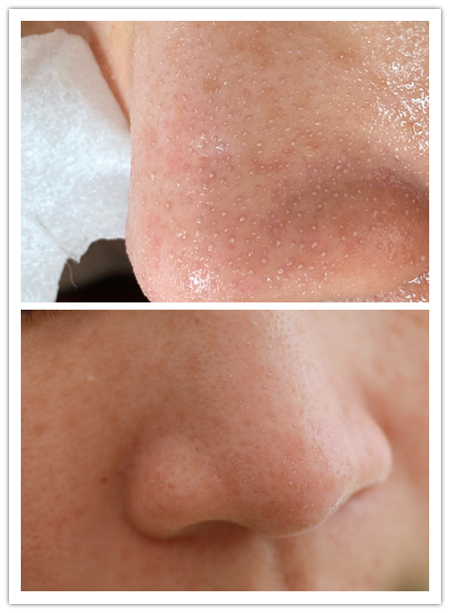 真人挑战去黑头,用完恢复婴儿肌