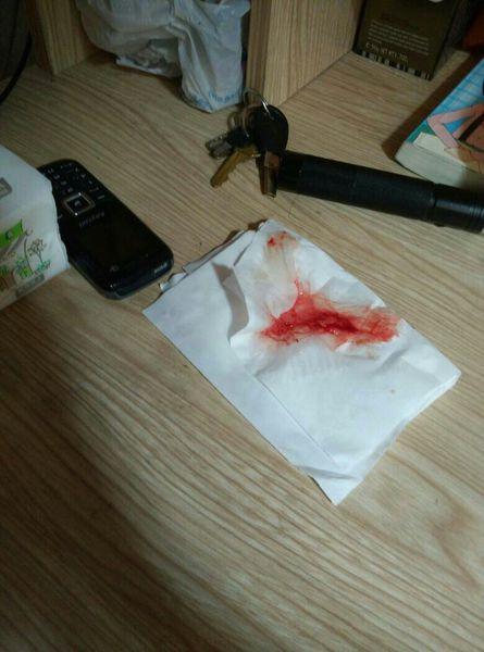 甩鼻涕出血怎么回事,好像没有流鼻血啊,应该不是上火吧.