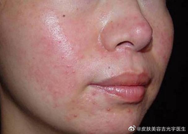 玫瑰痤疮容易被误诊的原因|炎症|痘痘|皮炎|瘙痒_网易