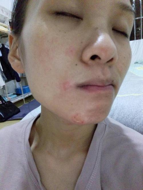 铜钱癣怎样治疗?