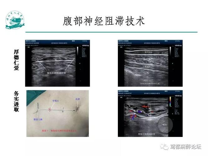 实用| 如何做好超声引导神经阻滞