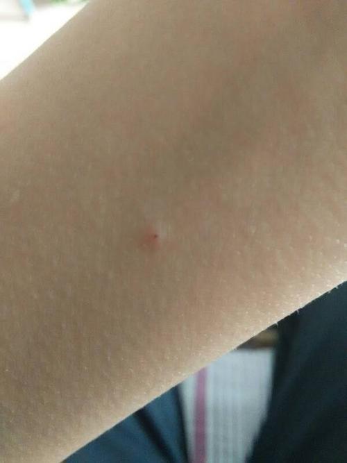 有干疮的人经常洗完澡在我的床上睡一下只穿个内裤我会不会被传染?