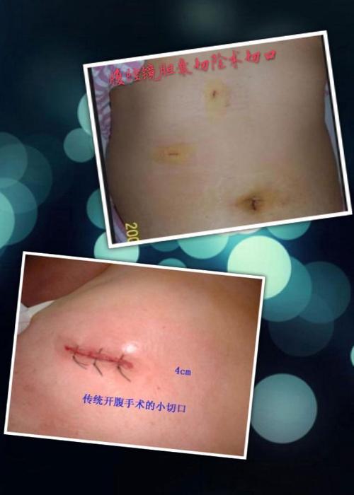 创伤大,伤口愈合慢,易出现并发症,导致患者痛苦大,术后恢复不良的问题