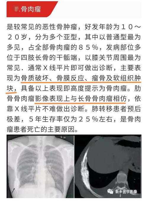 最后诊断:  肋骨 骨肉瘤  要点: 青少年 骨质破坏 瘤骨 软组织肿块