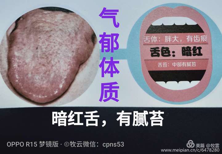 气郁体质暗红舌,有腻苔是指舌色暗红,舌体胖大,略有齿痕,但不明显