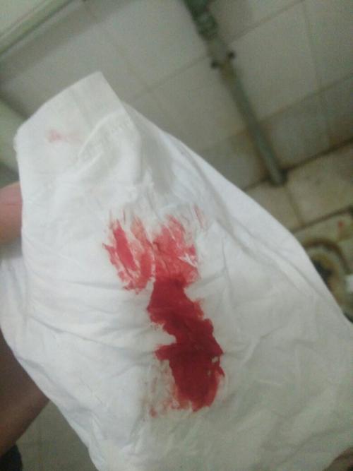 刚上完厕所 拉完 发现纸上竟然有血 本人22岁 男 第一
