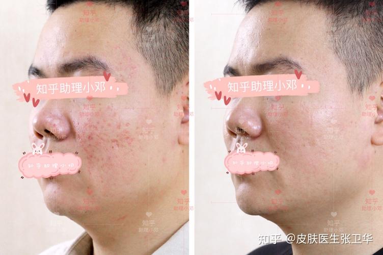 厢车型痘坑 冰锥型痘坑的混合类型痘坑 痘印 炎症,做了点阵激光一组后