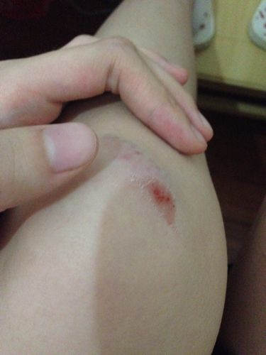 问:今天在楼梯那里摔了一下 这是膝盖部分 请问要紧么?会自己痊愈么?