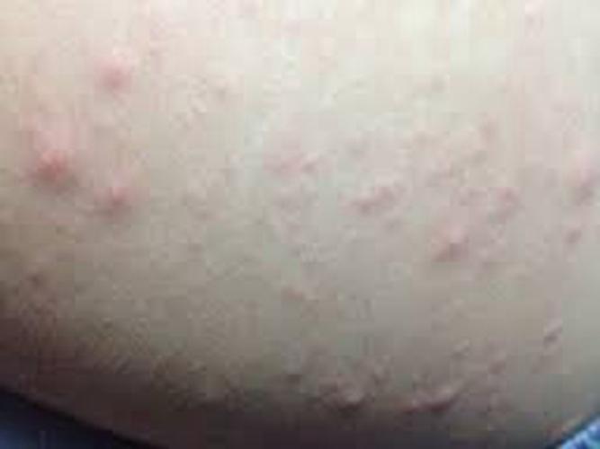 腿部夏季皮炎症状图片大全_有来医生