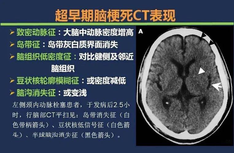没有mri,超早期如何利用ct诊断脑梗死
