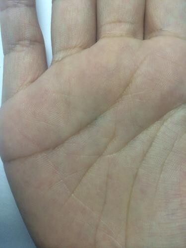 请问这是智慧线分叉还是断裂?有什么含义?手相综合怎样?