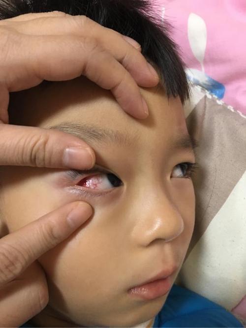 分享到:文章主题:68孩子的眼睛这是怎么了