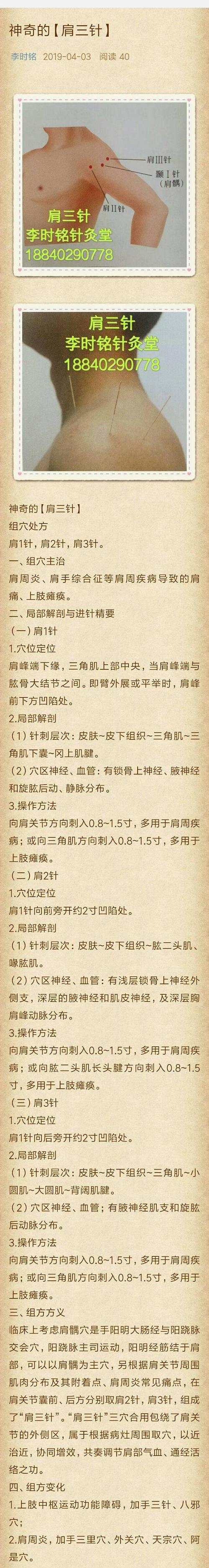 肩三针 颈三针 背三针 腰三针 坐骨针