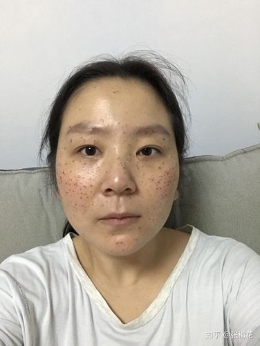 药水点斑记录 - 知乎