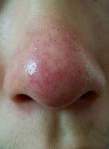 请问我这个是酒渣鼻吗?情况严重吗,该如何治疗才能好