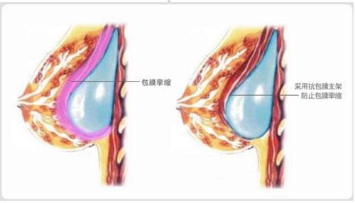 隆胸失败最大的体现就是后遗症