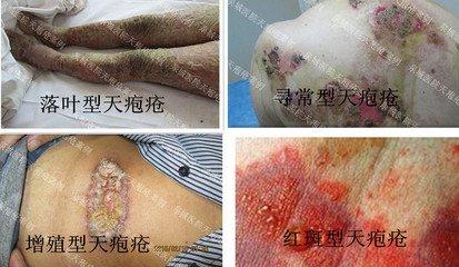 清毒养经疗法成功治愈天疱疮