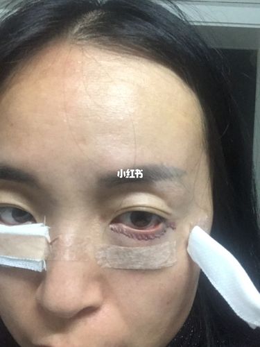 外切眼袋术后4个小时,下眼睑外翻_眼袋_美妆_医美整形
