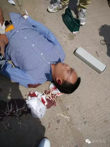 三马子与摩托车惨烈相撞,伤员七窍流血!