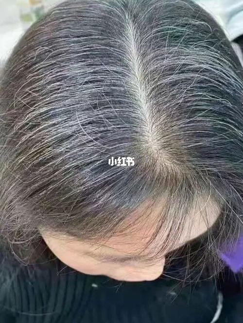 摆脱～白头困扰_白头_白发_医疗健康_医疗健康其他