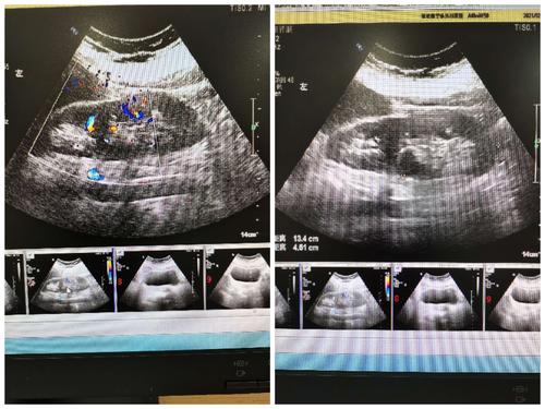 超声诊断肾脏畸形两例