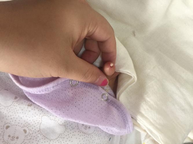 宝宝尿尿的地方有个白色脓包