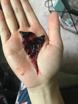 生化妊娠了 刚刚排除这个 想问下是不是内膜 图有不适