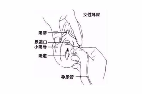 间歇性导尿患者的健康教育