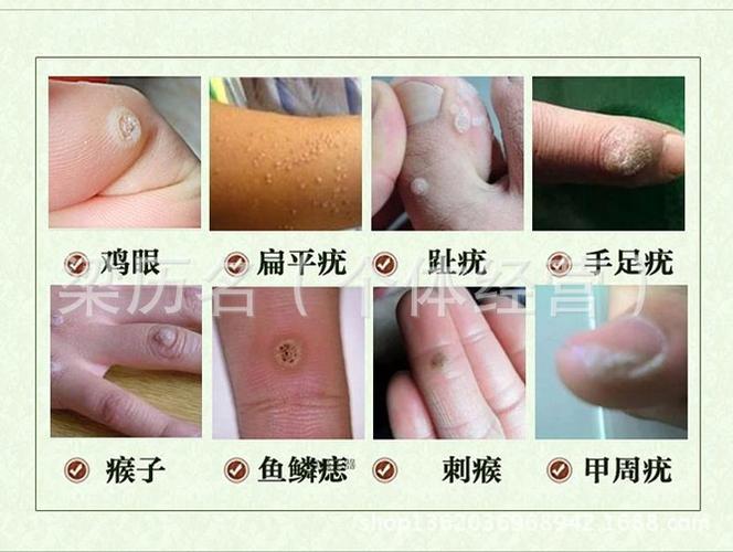历名脚艺除疣净趾疣刺瘊子鸡眼膏贴老茧丝状疣跖疣甲周疣鱼鳞痣