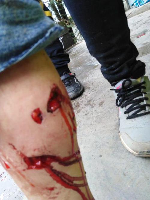 十岁的孩子被狗咬得很严重,肉都咬碎了,两只脚的小腿被咬了好几个洞