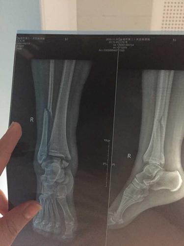 骨折是一种什么样的体验?