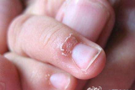 如何去除宝宝手上的"倒刺"!