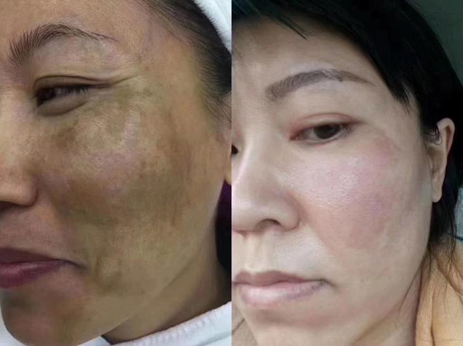 长斑容易,祛斑难!心再急,也要警惕铅汞,安全祛斑