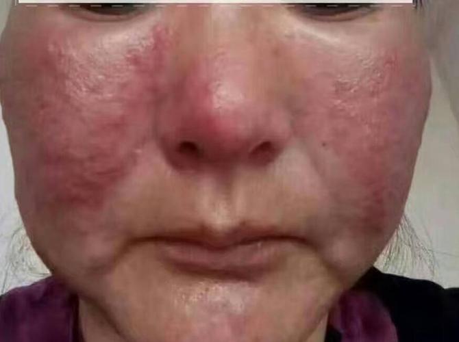 为什么速效产品会导致激素依赖性皮炎发生?