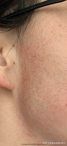 一个鸡皮肤女孩的改变之旅