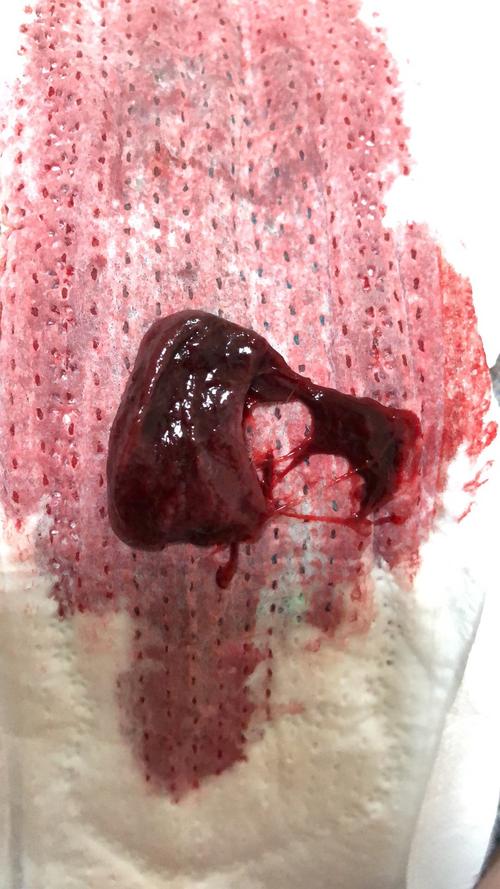 每次来大姨妈都有块状物出现 应该不是血块 像肉一样