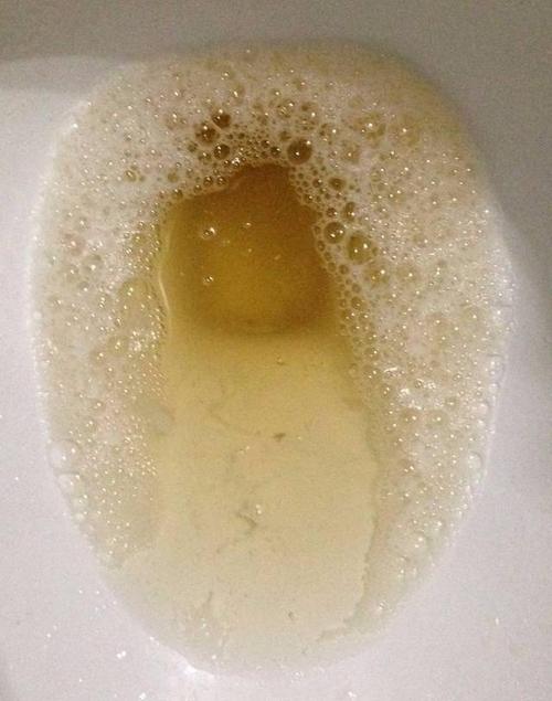 尿液中有泡沫,是肾脏出现了问题吗?别冲掉,做个5分钟的小检测