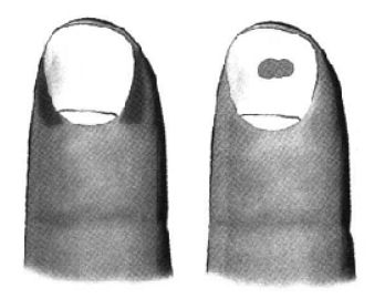 (22)多数指甲面中央出现有乌云状黑斑块,是患肝恶变病信号.