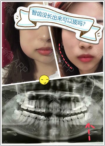 智齿到底要不要拔?