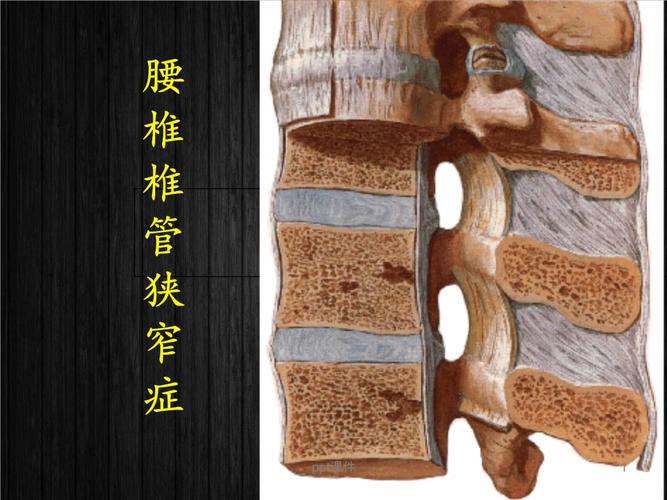 腰椎管狭窄症.ppt 21页