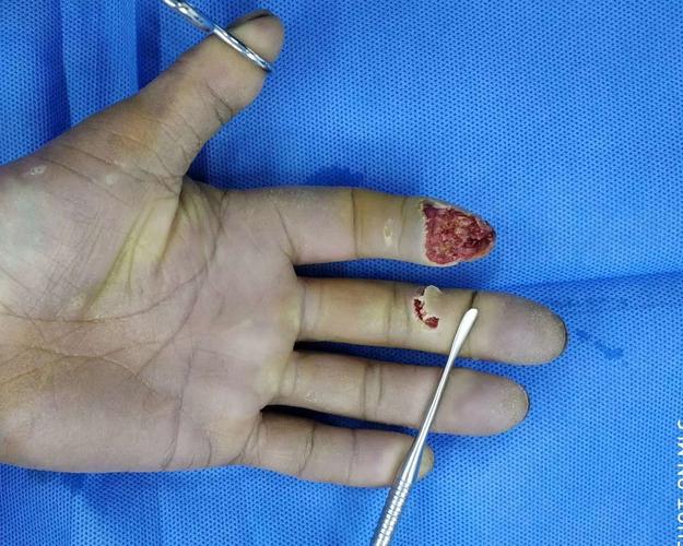 case2 左手示指末节指腹缺损