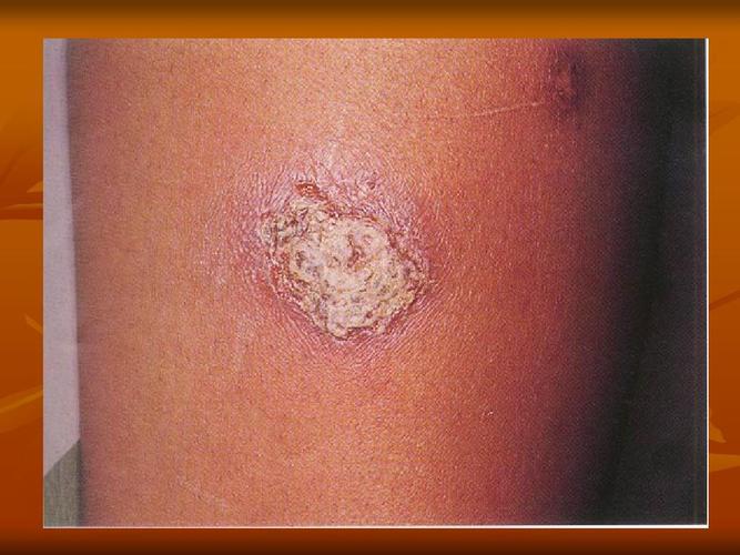 中西医结合课件 脓疱疮ppt