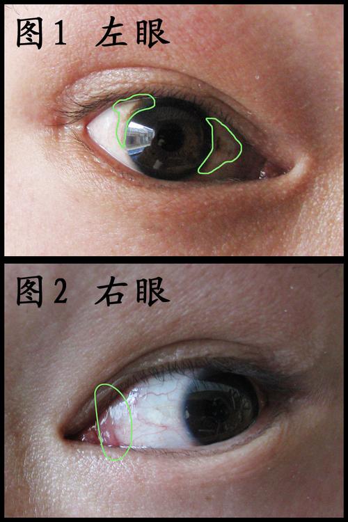 眼睛黄斑及有膜