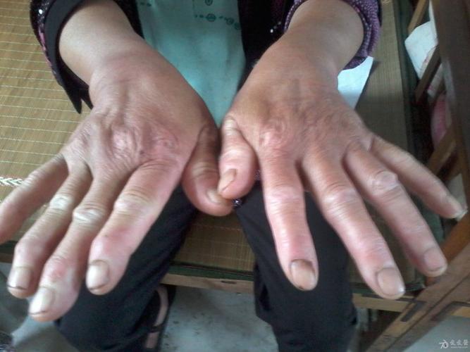 看图诊断治疔:双手关节痛,腰腿痛,全身痛月余,加重五天