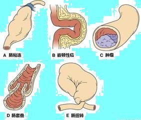 重视老年人肠梗阻