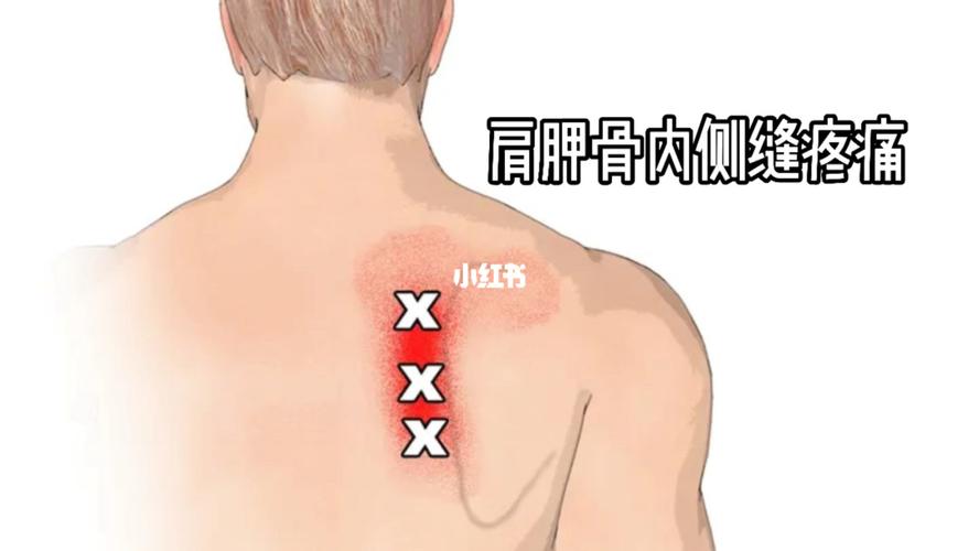 肩胛骨内侧缝疼痛评估_菲莱运动康复攻略_运动康复_肩胛骨缝疼_医疗