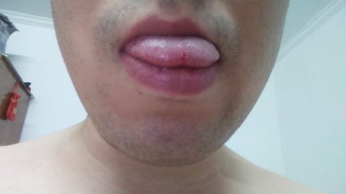 舌头尖上长小疙瘩